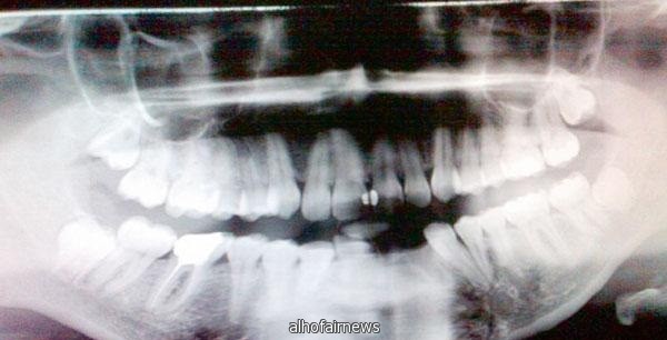 حقنة «ترامادول» تتسبب في كسر أسنان مريضة في مستشفى حكومي بالرياض